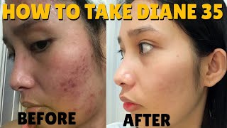 DIANE 35 CURING MY ACNE  HOW TO TAKE IT PROPERLY  Galy Gascon [upl. by Oicneconi]