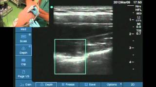 Suprascpular nerve block [upl. by Yerfdog397]