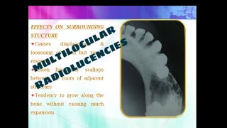 MULTILOCULAR RADIOLUCENCIES OF THE JAW [upl. by Allimak]