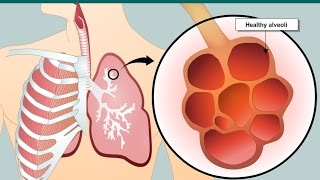 COPD and emphysema [upl. by Allecsirp509]