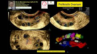 Ovarium Polikistik [upl. by Bremer]