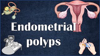 Endometrial Uterine Polyps  Everything You Need To Know [upl. by Nairolf]