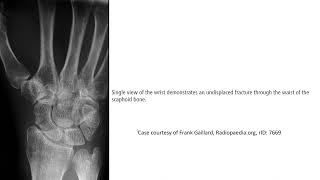 Scaphoid Fracture Imaging [upl. by Assirak]