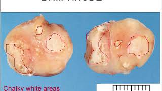 Chronic Lymphadenitis gross and microscopic features for medical students [upl. by Admana]