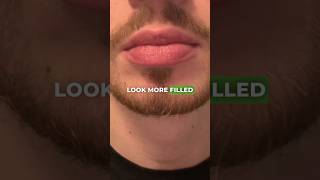 How To Remove Fordyce Spots in 20 Seconds🤩⏱️ [upl. by Gnaw]