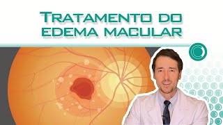 Tratamento do edema macular [upl. by Seraphine]