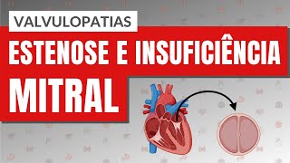 VALVULOPATIAS I PARTE 3 Estenose e Insuficiência mitral [upl. by Wayne643]