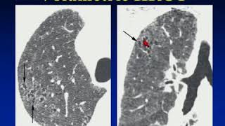 HRCT of lung  HD Basic Radiology [upl. by Candyce148]