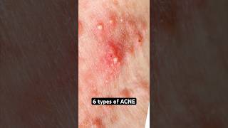 6 Types of Acne Explained shorts acne [upl. by Gora]