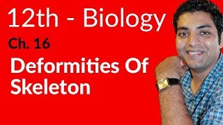 12th Class Biology  Deformities of skeleton  Ch 16  FSc Biology Book 2 [upl. by Ellennaj]