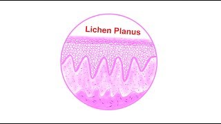 Lichen planus Histopathological features  Lets draw [upl. by Us]