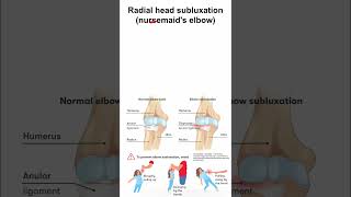 Radial head subluxation nursemaids elbow [upl. by Wellesley]