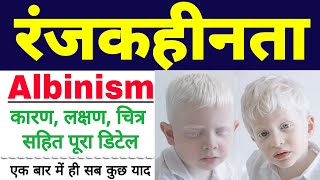 रंजकहीनता  Albinism disease in hindi  albinism class 12 biology  symptoms  biology ScienceSK [upl. by Elaynad]