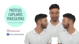 PRÓTESIS CAPILARES MASCULINAS  PRÓTESIS CAPILARES PARA HOMBRES EN MÁLAGA  SIN CIRUGÍAS [upl. by Lynnett]