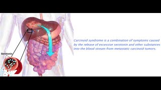 Carcinoid Syndrome [upl. by Sudoeht948]