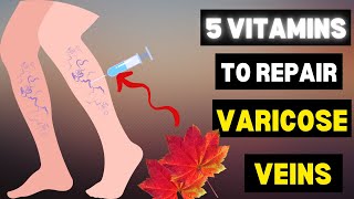 5 vitamins for venous insufficiency This is the Most Effective and Safest Remedy for Varicose Veins [upl. by Enerual]