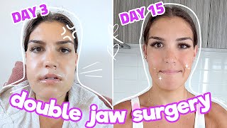 My Double Jaw Surgery Experience 2 WEEKS POST SURGERY Ep 5 [upl. by Massimo924]