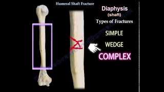 Humeral Shaft Fracture  Everything You Need To Know  Dr Nabil Ebraheim [upl. by Keiko391]