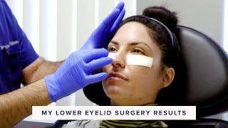 Real Lower Blepharoplasty Recovery amp Results  In the OR Part 3 of 3 [upl. by Rolandson638]