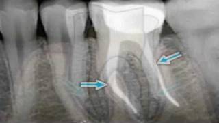 What is Endodontics [upl. by Lodi]