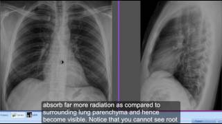 Differentiate Left and Right hemidiaphragms on chest xray lateral view [upl. by Eimot438]