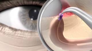 Punctum plug procedure  animation [upl. by Vijnas]