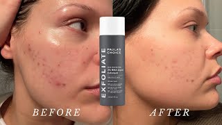 How to properly use the Paulas Choice 2 BHA Liquid Exfoliant  Dos and Donts [upl. by Lah]