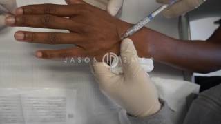 Radiesse Hand Rejuvenation  AntiAging and Wrinkle Reduction  Los Angeles [upl. by Oly]