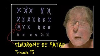 Síndrome de Patau Trisomía 13 [upl. by Liamsi]