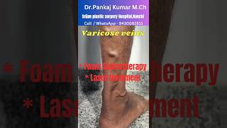 Varicose veins treatment for SSC GD medical Best varicose veins treatment shorts varicoseveins [upl. by Wulfe]