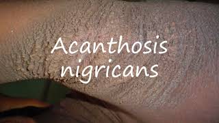 How to Pronounce Acanthosis nigricans [upl. by Vashtia]