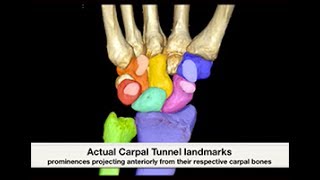 CS Carpal Tunnel Bifid Median Nerve  Sonosite [upl. by Laraine559]