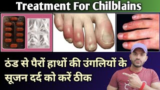 treatment for chilblains ठंड से पैरों हाथों के सूजन दर्द को करें ठीक [upl. by Kcirdla]