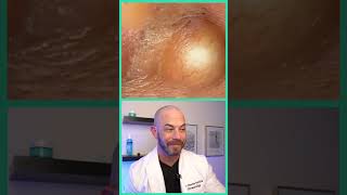 Doctor reacts to juicy cyst pop dermreacts doctorreacts pimplepop [upl. by Shirline]