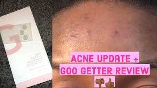 Goo Getter Zitsticka Review on my Acne  Forehead amp Skin Update  My 2021 New Year Skin Resolutions [upl. by Anirrehs754]