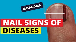 10 Nail Signs of Health Problems Subungual Melanoma Finger Clubbing Nail Pitting Brittle Nails [upl. by Crandall838]