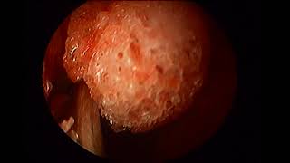 Right prelacrimal approach with septal correction unedited [upl. by Ynes47]