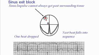 ECG Sinus Exit Block [upl. by Atiran]