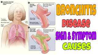 Bronchitis treatment Bronchitis cough and sound [upl. by Enutrof]