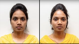 HydraFacial Treatment Before amp After Chennai for Younger Skin [upl. by Terryl]