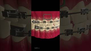 How Does Dental Braces Work [upl. by Abagael958]