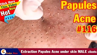 Extraction Papules Acne under skin MALE clients  Acne Treatment 116 [upl. by Cargian]