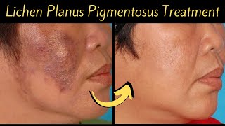 How to cure new type of Pigmentation “Lichen Plans Pigmentosus”  झाँइयों की नयी क़िस्म [upl. by Alue]