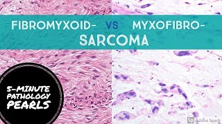 FIBROmyxo vs MYXOfibro Sarcoma Made Simple 5Minute Pathology Pearls [upl. by Lucien]