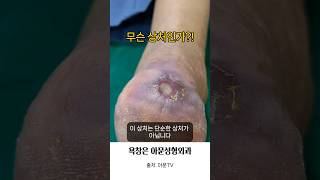 무슨 상처 인가 발뒤꿈치 욕창 소독 치료 병원 성형외과 bedsore pressure sore dressing seoul korea아문TV [upl. by Allcot]