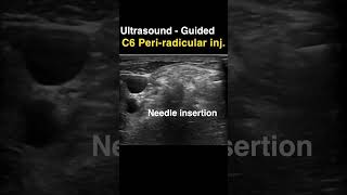 Sonoguided C6 periradicular injection [upl. by Airehc743]