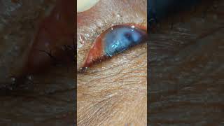 TRICHIASIS  Entropion  Eye doctor referred this case for permanent eyelash removal [upl. by Teplica811]