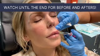 Volbella Lip Filler With Before and After Photos [upl. by Anelliw]