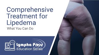 Comprehensive Treatment for Lipedema What You Can Do [upl. by Natehc]