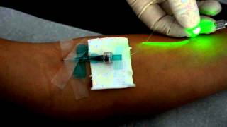 Intravenöse Laserblutbestrahlung mit dem Weberneedle® Endo Laser [upl. by Byran]